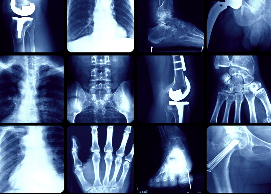 Digital X-ray